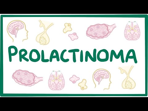 Prolactinoma - causes, symptoms, diagnosis, treatment, pathology