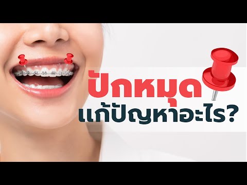 ปักหมุด เเก้ปัญหายิ้มเห็นเหงือกได้ยังไง⁉️ I หมอฟัน SmileBox