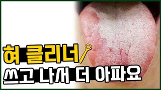 혀클리너로 긁고 나서 혀가 더 아파요