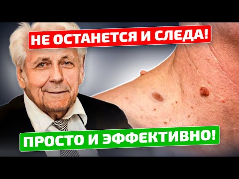 Неумывакин: Папилломы с корнем отвалятся! Как избавиться от папиллом народным средством