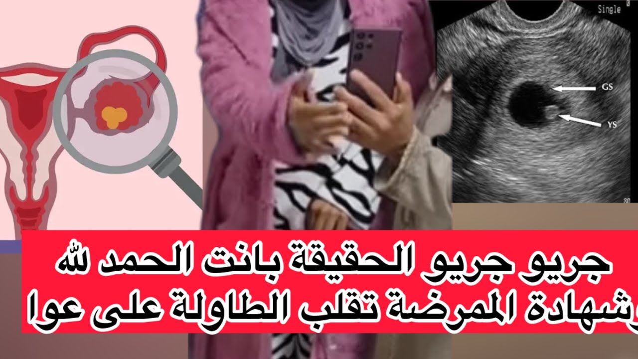 خط_ير وعاجل حصريا من عند الممرضة لي خدامة في نفس الكلينيك😱حقيقة كيس المبيض والعملية المستعجلة؟✅