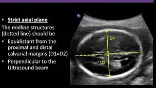 TMT: FETAL IMAGING:  Imaging The Lateral Ventricles | ALPANA JOSHI | Fetal Hydrocephalus