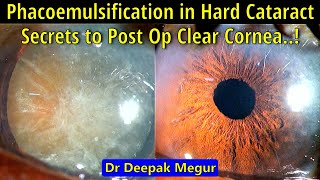 Phacoemulsification in Hard Cataract - Secrets to Post Op Clear Cornea..! Dr Deepak Megur
