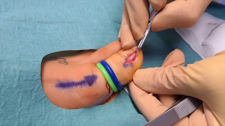 Video - Winograd procedure for spiculectomy post TNA
