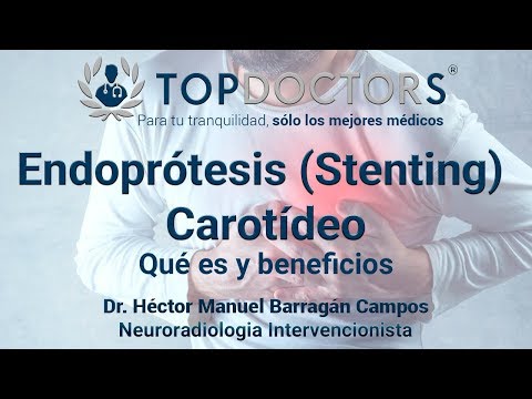 ¿Cuáles son los beneficios de Stenting Carotídeo? Descubre todos los detalles