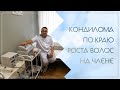 ↪ Кондилома по краю роста волос на члене. Клинический случай №87