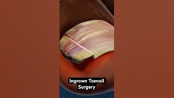Removing a painful ingrown toenail (3D Animation)
