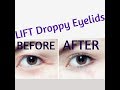 LIFT AND TIGHT DROOPY EYELIDS AND SAGGING EYEBROWS