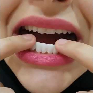 Perfect Smile Teeth SNAP ON VENEERS - Snap on teeth | EllePeri - Instant Smile Snap-On Smile Veneers