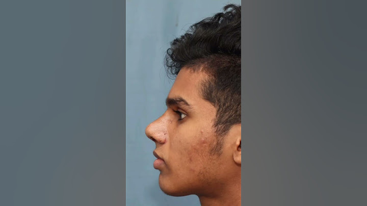 Best Result After Rhinoplasty In India | Before & After Results | Dr Mathew PC #shorts