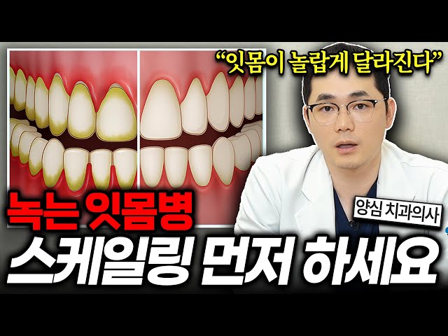 [강남치과] 스케일링 후 시리고 잇몸에 구멍이 났다면 봐야 할 영상. 치과에서 임플란트 전에 스케일링 먼저 하는 이유 #신사동치과 #신사역치과