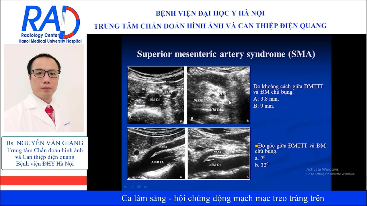 Hội chứng động mạch mạc treo tràng trên: Bệnh lý nguy hiểm đến tính mạng nếu không điều trị kịp thời