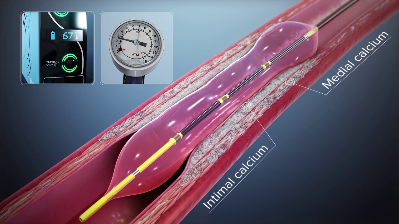 Shockwave Intravascular Lithotripsy IVL System Mechanism Of Action