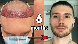 6 MONTH HAIR TRANSPLANT UPDATE: My hair care routine to preserve my hair