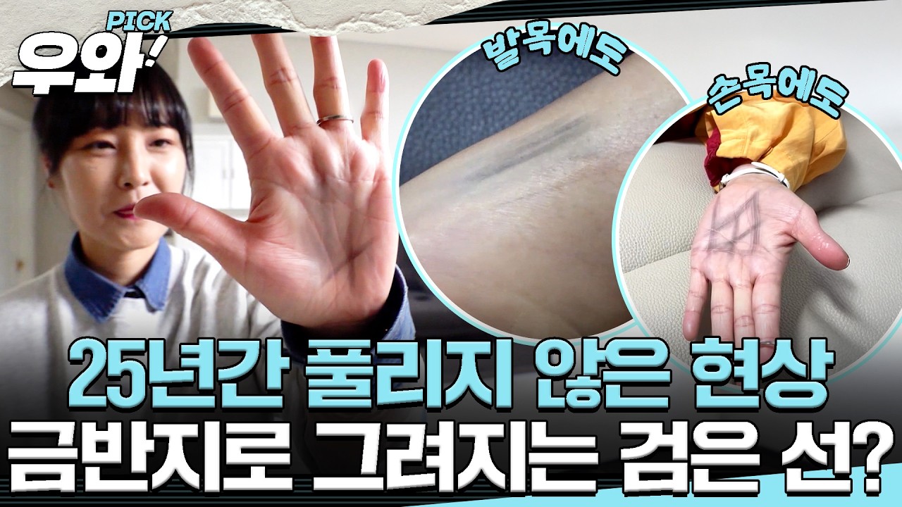 [#세상에이런일이] '엄마의 몸에 그림이 그려져요!' 금반지로 만들어지는 신기한 현상💍 #우와비