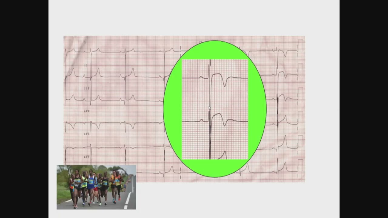 ECG de repos  du sportif
