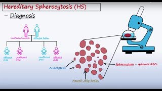 Hereditary Spherocytosis (HS) - Pathophysiology