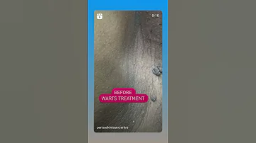 Genital Warts Treatment Dr Ashima Goel Shorts 