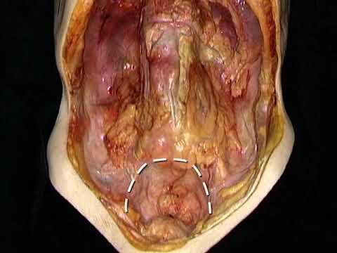Vídeo: Inflamació De La Cavitat Abdominal Del Gos - Cavitat Peritoneal Del Gos