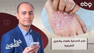 خط مفتوح - علاج الصدفية بالغذاء والطرق الطبيعية