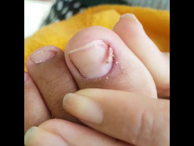 COMO FAZER AS UNHAS DOS PÉS E DESENCRAVAR.PARA INICIANTES
