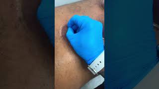 ?Trending Cupping Therapy hijama youtubeshorys zubi trending viral foryou pleasesubscribe