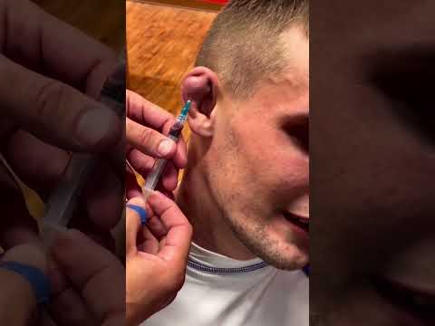 Cauliflower ear draining Pt. 2 👂🏼 💉