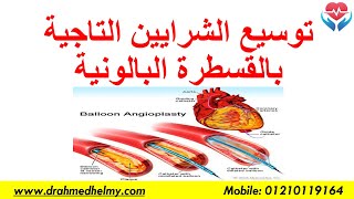 توسيع الشرايين التاجية بالقسطرة البالونبة