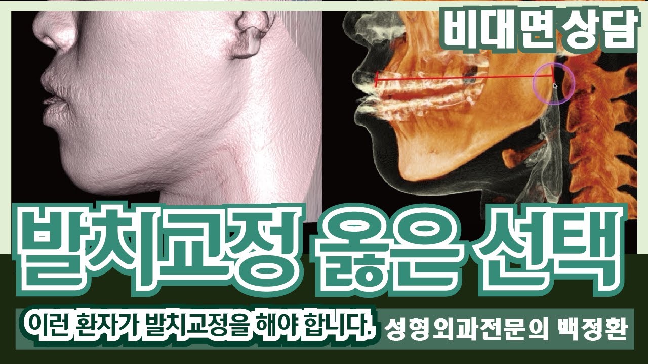 (SUB) 발치교정은 옳은 선택이었어요. 중안면부는... [비대면상담 229] / Tooth extraction ...