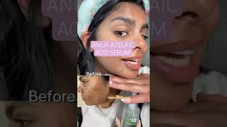 Anua Azelaic Acid Serum For Dark Spots Real Results Review