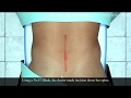 Lumbar Surgery Animation | Spinal Cord Surgery Animation