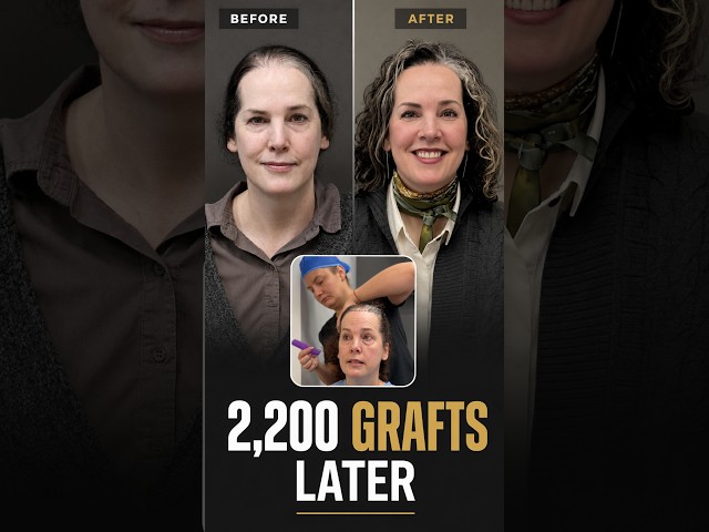 She DMed a Stranger About Her Hair Transplant. That Stranger Changed Everything.