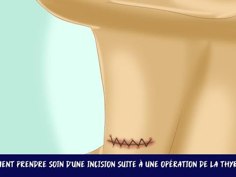 Vidéo: 3 façons de prendre soin d'une incision après une chirurgie de la thyroïde