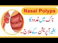 Naak ki gadood ka ilaj in urduhindi  without operation  nasal polyps treatment  naak ki hadi