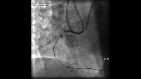 Aortic dissection and radial rupture during retrograde CTO PCI: Management of complications VİDEO 15