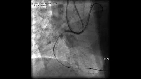 Aortic dissection and radial rupture during retrograde CTO PCI: Management of complications VİDEO 15