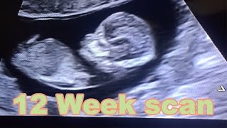 Cute & clear ultrasound of baby Micah | 12 Week scan!