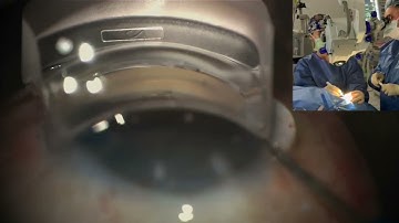 iTrack Advance Canaloplasty by Dr. Nicole Bajic at Cole Eye Institute