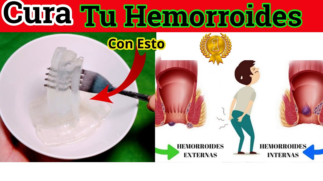Cómo Curar Las Hemorroides internas y Externas | Con 1 Simple Remedio