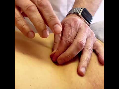 Иглорефлексотерапия при боли в спине