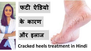 फटी एड़ियों के कारण और ईलाज। Cracked heels causes & treatment | home remedy| डॉ आँचल पंत screenshot 2