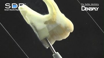 SDR® - Self-leveling Bulk Fill Composite | Dentsply Sirona