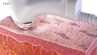 Thermal Fractional Microneedling RF Machine | Non-Laser Skin Resurfacing & Rejuvenation System
