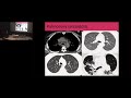 Cleveland conference 2018 sarcoidosis an overview  dr manuel ribeiro