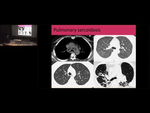 Cleveland Conference 2018: Sarcoidosis: An Overview - Dr. Manuel Ribeiro