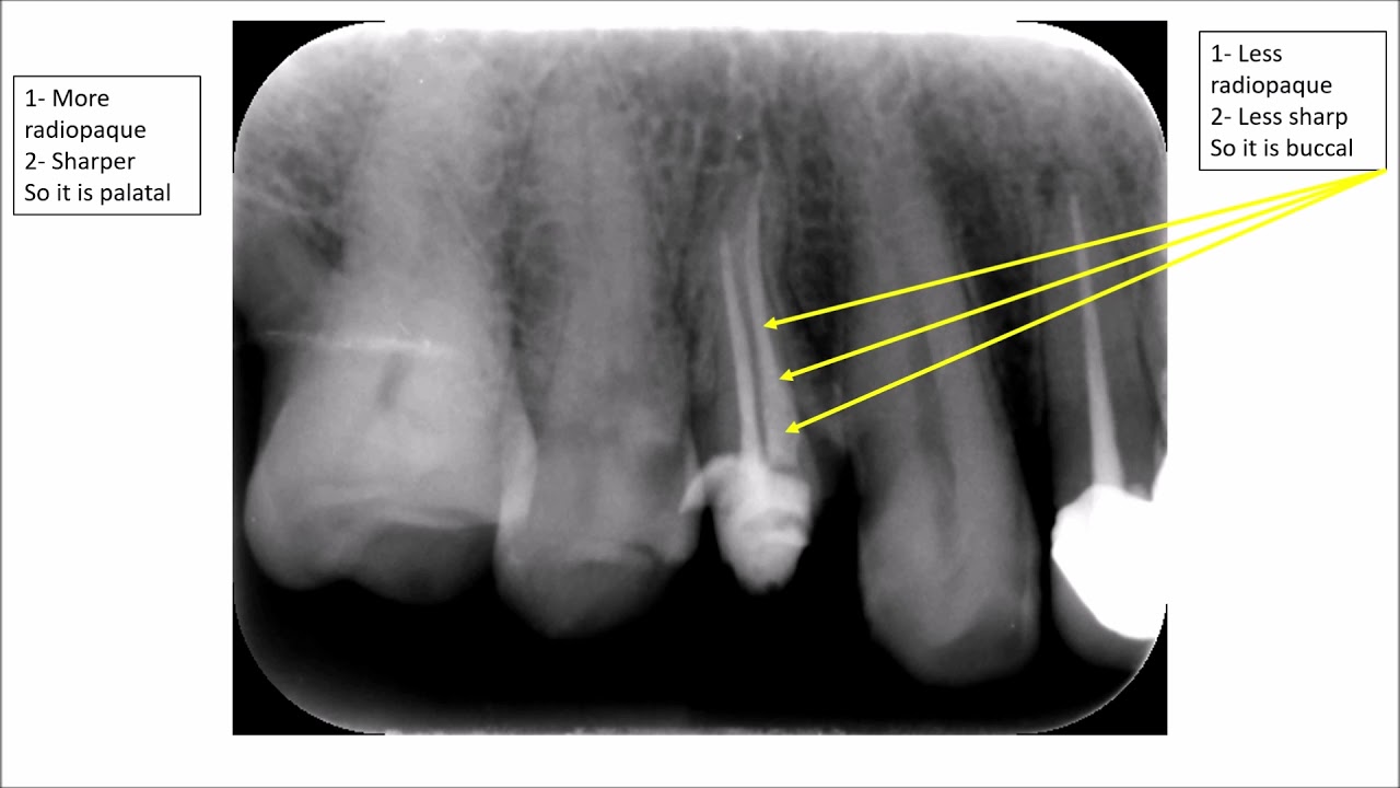 How to Locate the Position of Structures in 2D Radiographs 1 - YouTube