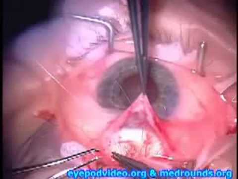 Mitomycin C Trabeculectomy for Treatment of Glaucoma