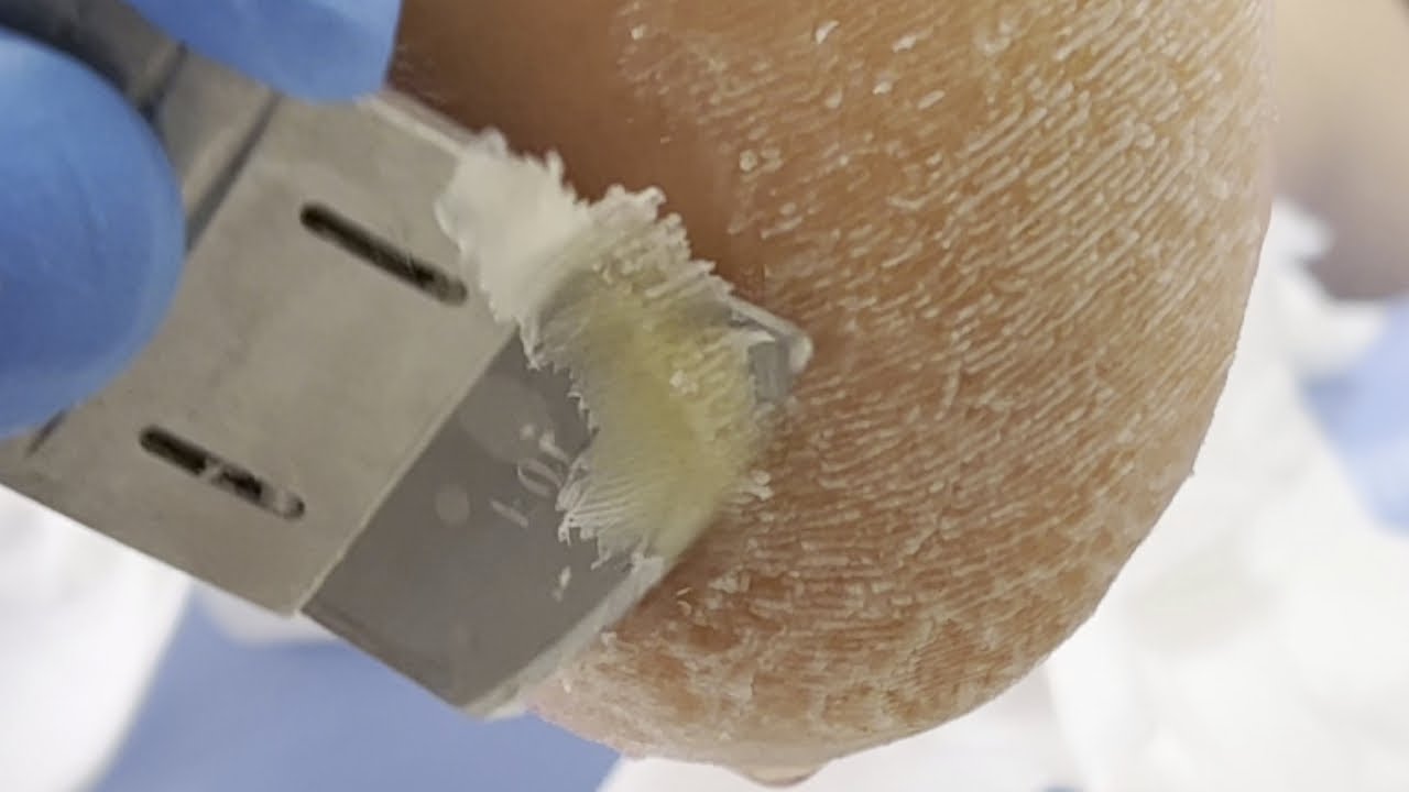 Scrape off the dead skin layer by layer【Xue Yidao Pedicure】 YouTube