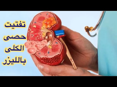 تفتيت حصى الكلى بالليزر
