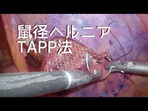 TAPP法による腹腔鏡下鼠径ヘルニア修復術の解説『ラパヘル』